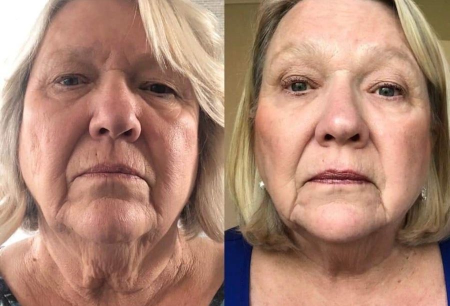 Before / After